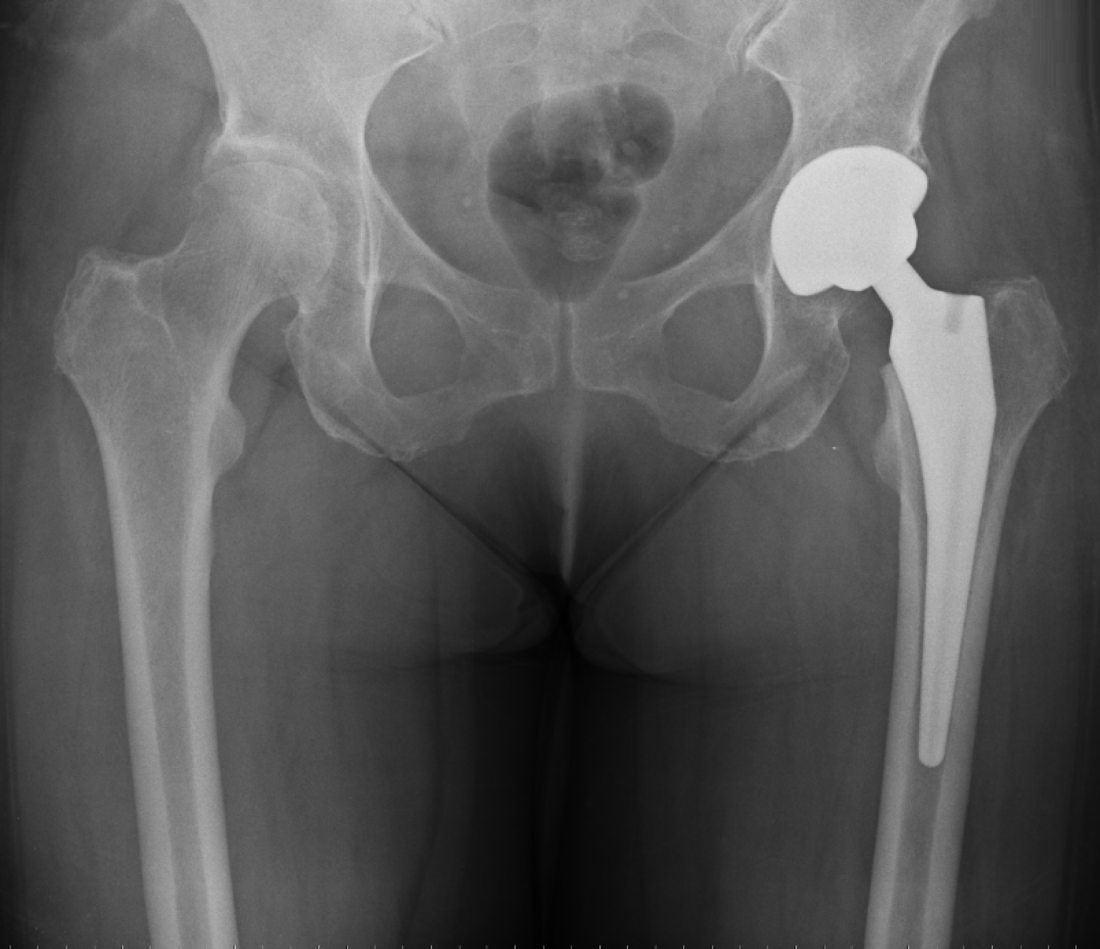 Hip Arthritis Treatment in London | Mr Kam Cheema
