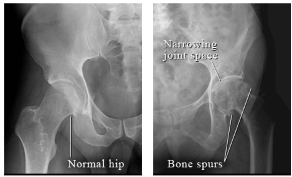 Hip Arthritis Treatment in London | Mr Kam Cheema