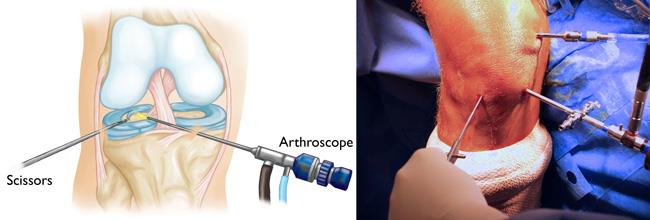 Knee Arthroscopy in London | Mr. Kam Cheema