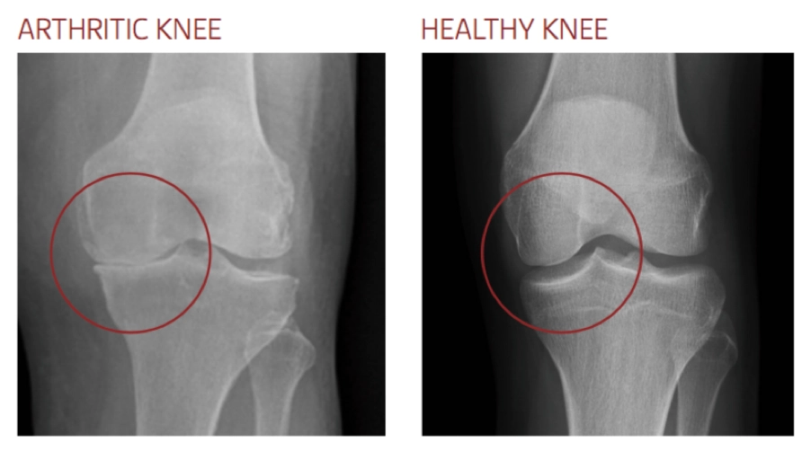 Knee Arthritis Treatment in London | Mr Kam Cheema