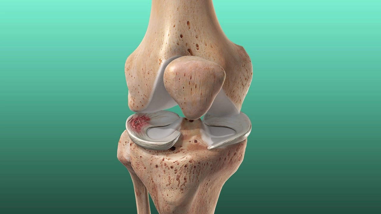 Meniscal Injury Treatment in London | Mr. Kam Cheema
