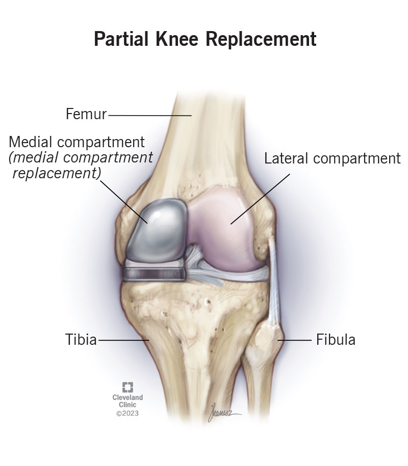 Unicompartmental Knee Replacement in London | Mr. Kam Cheema