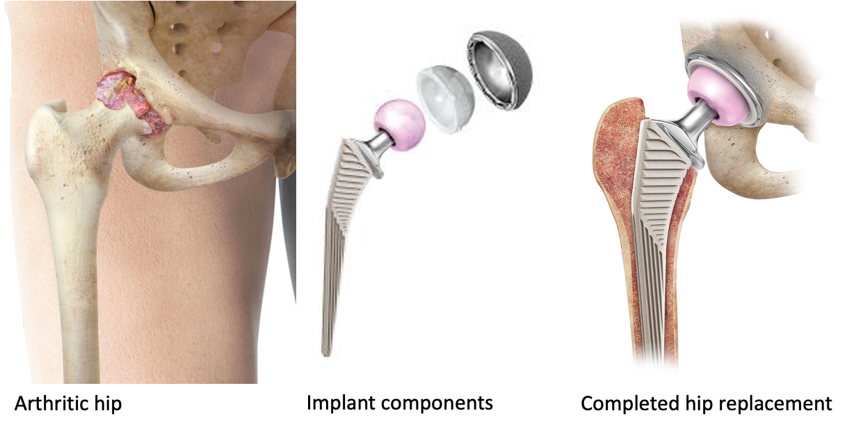 Total Hip Replacement in London | Mr Kam Cheema
